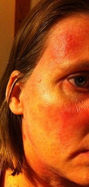 Eczema on face