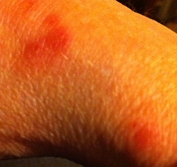 Eczema on hand and wrist