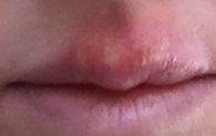 Day two of cold sore