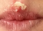garlic lips