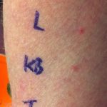 Allergy skin prick test