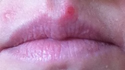 Testing Herstat cold sore ointment - day 4