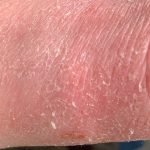 topical steroid withdrawal