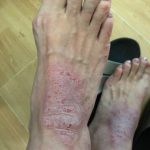 bad foot eczema