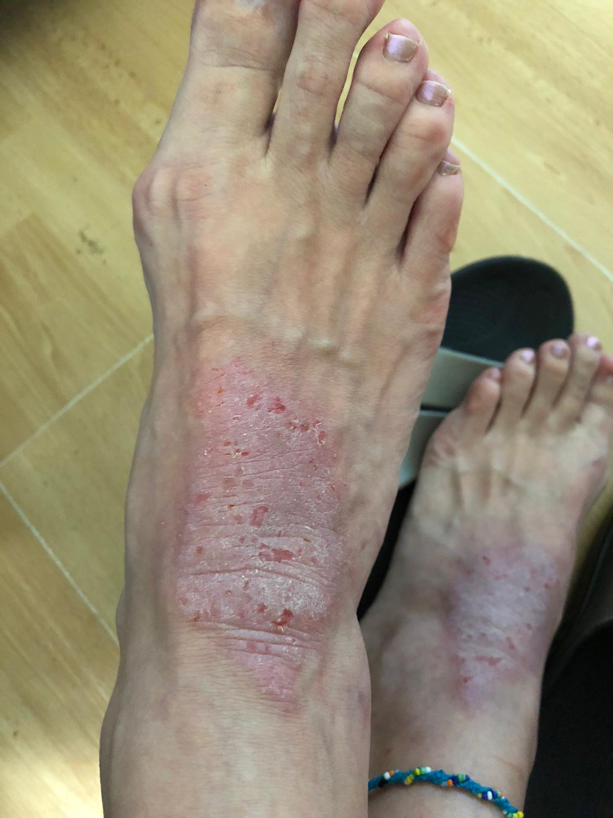 mild eczema on feet