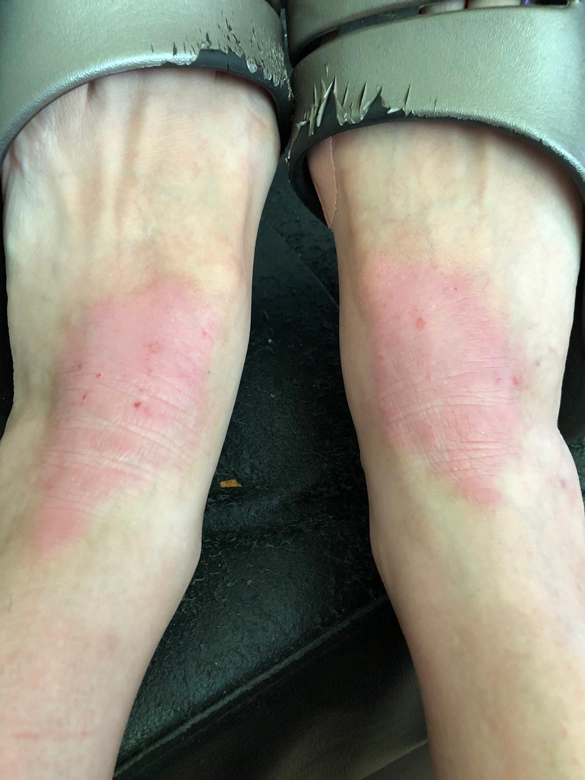 Dyshidrotic Eczema Bottom Of Foot