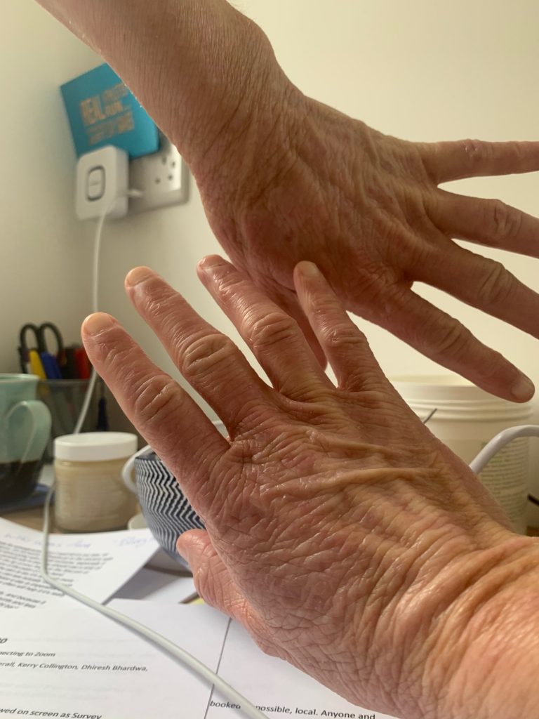 healing hand eczema with Silipos gel gloves